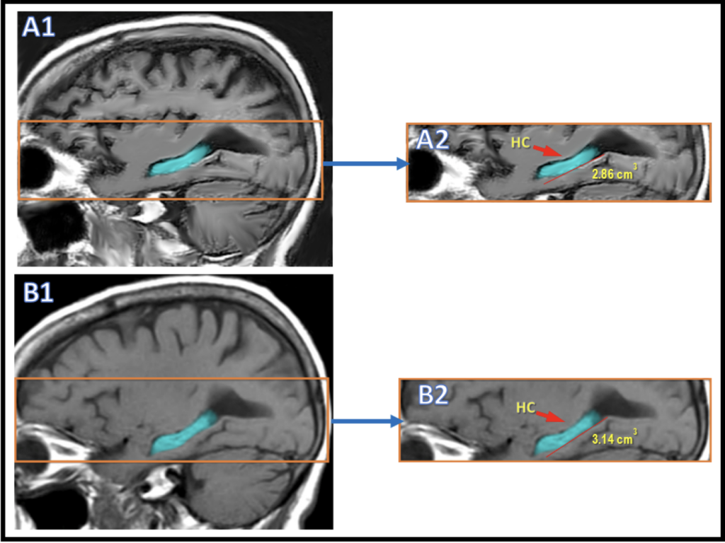 brain fitness program MRI results