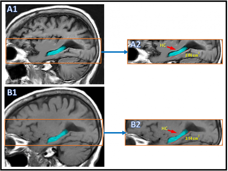 brain MRI for concussion rehabilitation and TBI