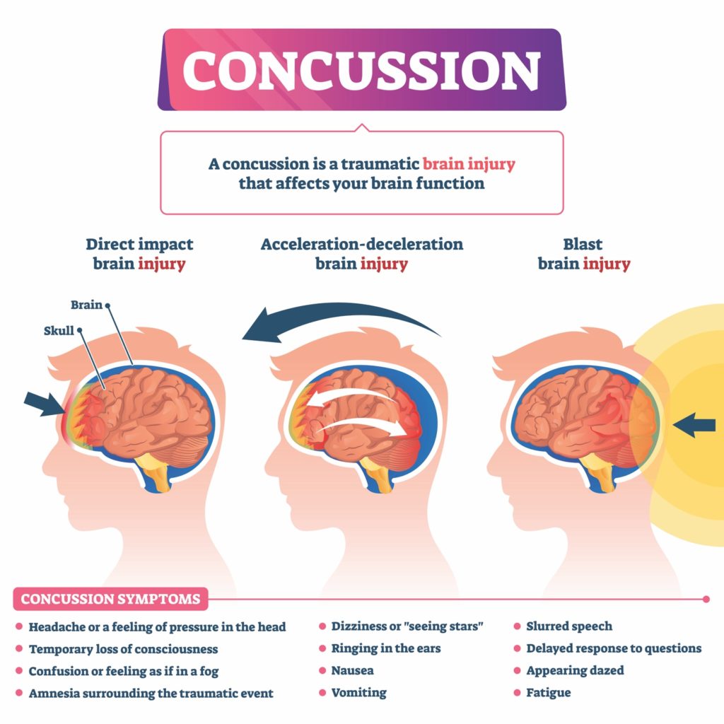 biofeedback and concussions